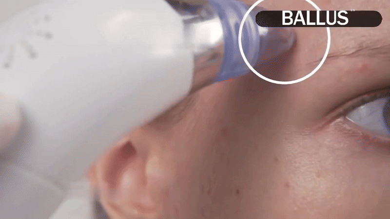 Pore Vacuum Blackhead Remover – Deep Clean for Radiant Skin